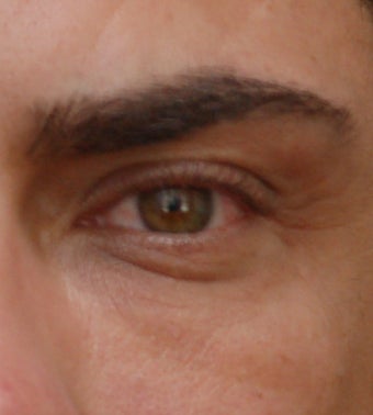 Lower Lid Blepharoplasty and F/U Dermafiller Treatment after 96877