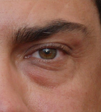 Lower Lid Blepharoplasty and F/U Dermafiller Treatment before 96877