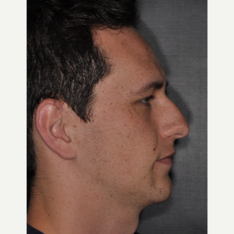 18-24 year old man treated with Rhinoplasty 6 weeks post-op before 3499612