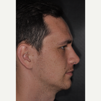 18-24 year old man treated with Rhinoplasty 6 weeks post-op after 3499612