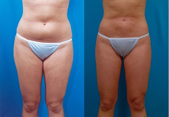 27-year-old woman treated with Liposuction. before 574521