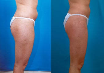 27-year-old woman treated with Liposuction. after 574521