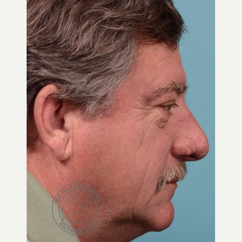55-64 year old man treated with rhinophyma before 3092641