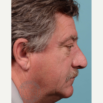 55-64 year old man treated with rhinophyma after 3092641