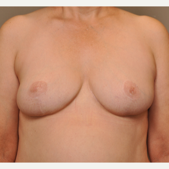 45-54 year old woman treated with Breast Reduction after 3495065