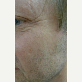 Fraxel laser for sun spots and skin rejuvenation after 1785093