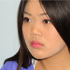 18-24 year old woman treated with Rhinoplasty before 3506342