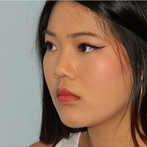 18-24 year old woman treated with Rhinoplasty after 3506342