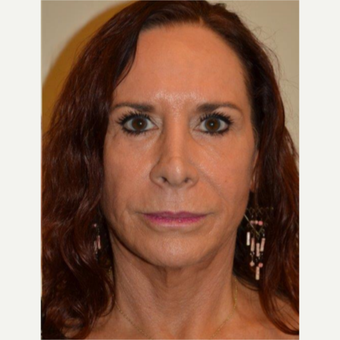 55-64 year old woman treated with Facelift after 3664421
