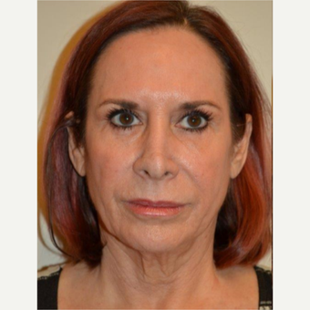 55-64 year old woman treated with Facelift before 3664421