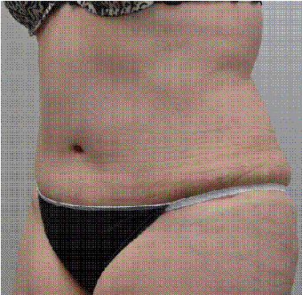 53-year-old woman undergoes tummy tuck and liposuction 1417384