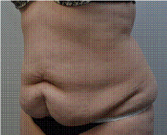 53-year-old woman undergoes tummy tuck and liposuction 1417384