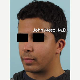 18-24 year old man treated with Buccal Fat Removal before 3266813