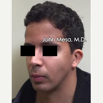 18-24 year old man treated with Buccal Fat Removal after 3266813