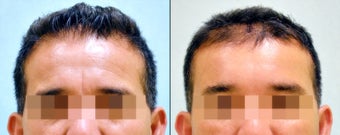 Endoscopic Brow Lift before 962234