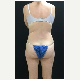 25-34 year old woman treated with Liposuction to Abdomen & Thighs after 3200818