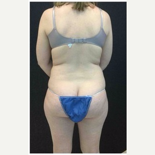 25-34 year old woman treated with Liposuction to Abdomen & Thighs before 3200818