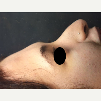 18-24 year old woman treated with Rhinoplasty before 3211746