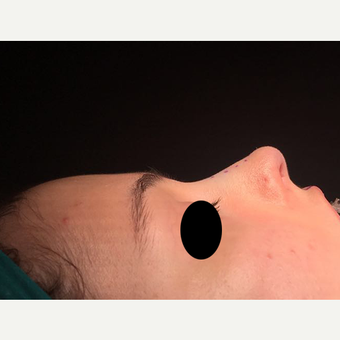 18-24 year old woman treated with Rhinoplasty after 3211746