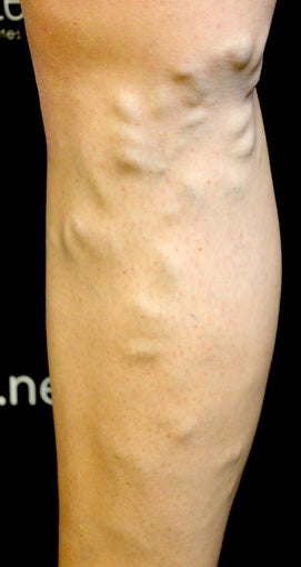 42 Year Old Woman Treated for Varicose Veins before 1136069