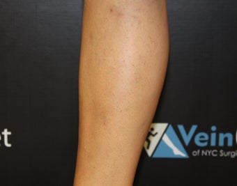 42 Year Old Woman Treated for Varicose Veins after 1136069