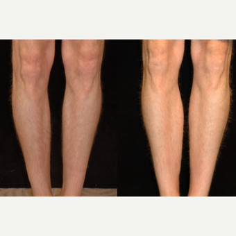 25-34 year old man treated with Calf Implant before 3659521