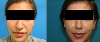 Rhinoplasty 26 Year Old Woman before 1098173