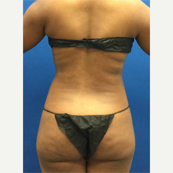 25-34 year old woman treated with Laser Liposuction before 3142101