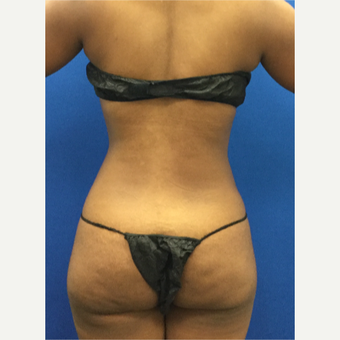 25-34 year old woman treated with Laser Liposuction after 3142101