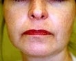 53 year old female patient before 933112