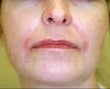 53 year old female patient after 933112