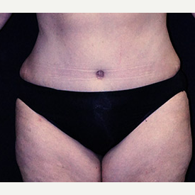 Tummy Tuck and Breast Reduction after 3332886