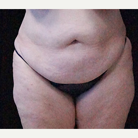 Tummy Tuck and Breast Reduction before 3332886