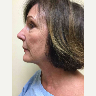 45-54 year old woman treated with Liposuction after 3775344