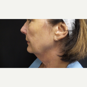 45-54 year old woman treated with Liposuction before 3775344