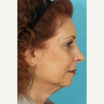55-64 year old woman treated with Facelift before 3691403