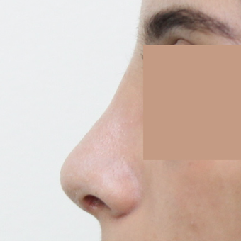 25-34 year old woman treated with Rhinoplasty after 3565678