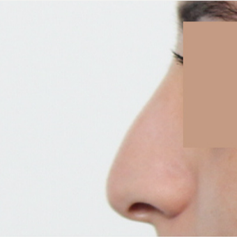 25-34 year old woman treated with Rhinoplasty before 3565678