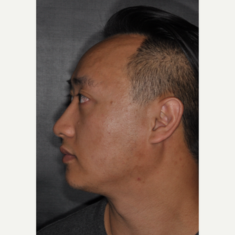 35-44 year old man treated with Rhinoplasty 8 months post-op after 3499947