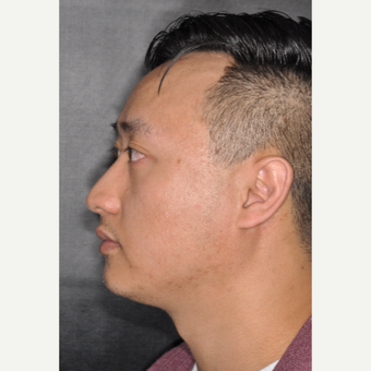 35-44 year old man treated with Rhinoplasty 8 months post-op before 3499947