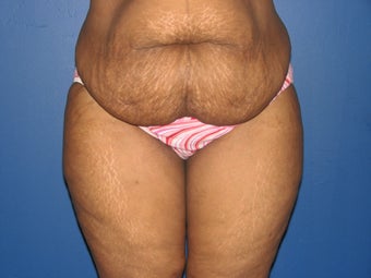 45 year old mother of 2 with a tummy tuck 1098420