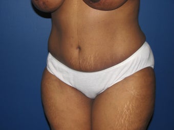 45 year old mother of 2 with a tummy tuck after 1098420