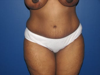 45 year old mother of 2 with a tummy tuck 1098420