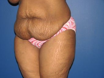 45 year old mother of 2 with a tummy tuck before 1098420