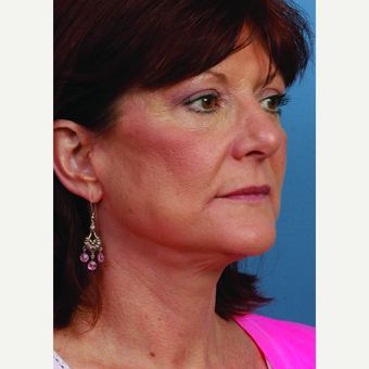 55-64 year old woman treated with Facelift after 3696754