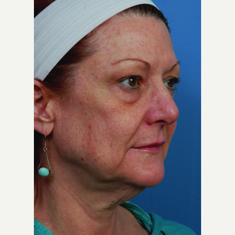 55-64 year old woman treated with Facelift before 3696754