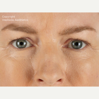45-54 year old woman treated with Xeomin after 2989039