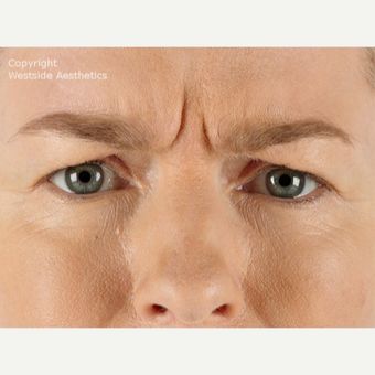 45-54 year old woman treated with Xeomin before 2989039