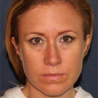 37 year old woman treated with 1 syringe of Restylane for under eye hollowness/tear troughs before 3059854