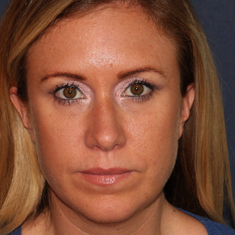 37 year old woman treated with 1 syringe of Restylane for under eye hollowness/tear troughs after 3059854